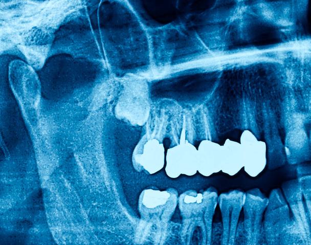 Cost Of Wisdom Tooth Removal Joondalup